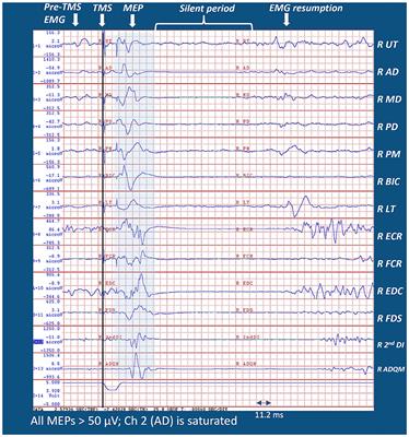 TMS assessment of corticospinal tract integrity after stroke: broadening the concept to inform neurorehabilitation prescription